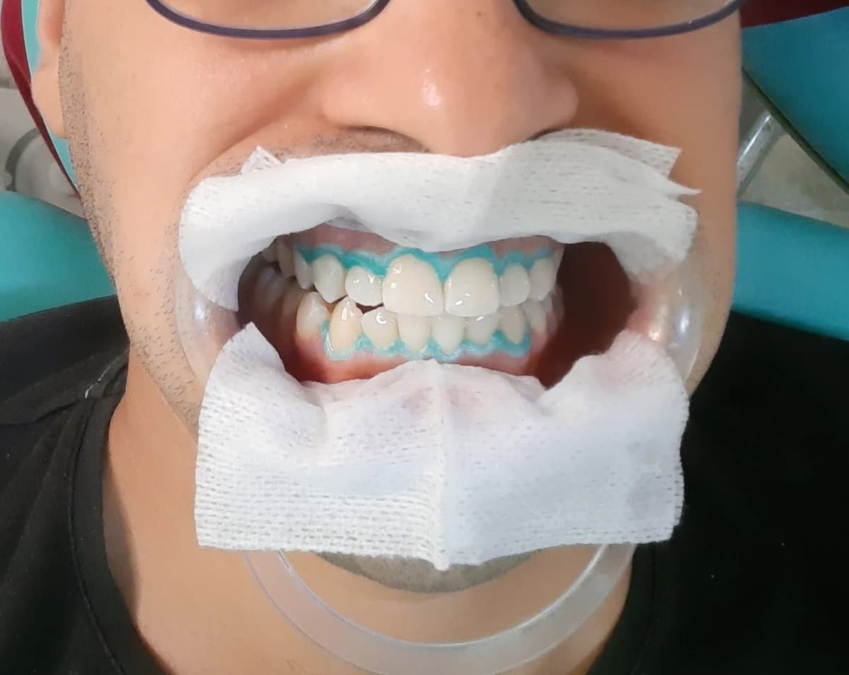 Sourire éclatant après un blanchiment dentaire professionnel